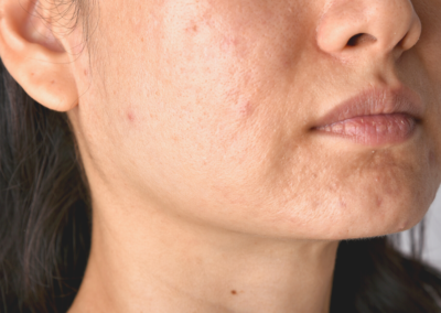 Scarring &  Acne Scarring Treatment